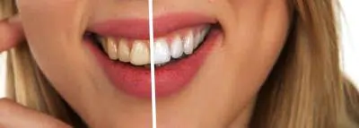 Blanchiment dentaire et mutuelle : ce qu'il faut savoir blanchiment-dentaire